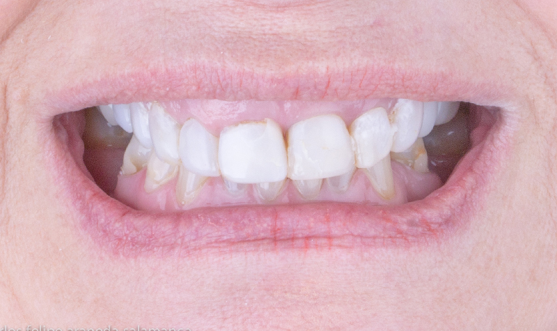 Rehabilitación oral completa Clínica Vallegrande