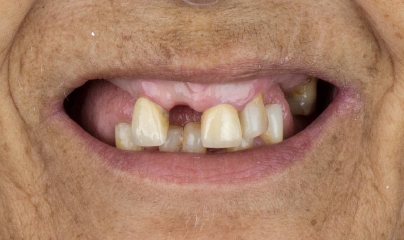 Rehabilitación oral completa Clínica Vallegrande