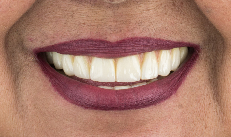 Rehabilitación oral completa Clínica Vallegrande