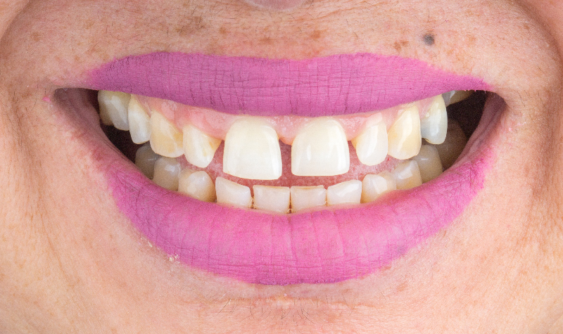 Rehabilitación oral completa Clínica Vallegrande