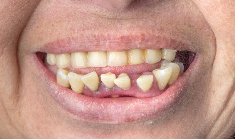 Rehabilitación oral completa Clínica Vallegrande