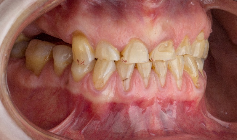 Rehabilitación Oral total Clínica Vallegrande