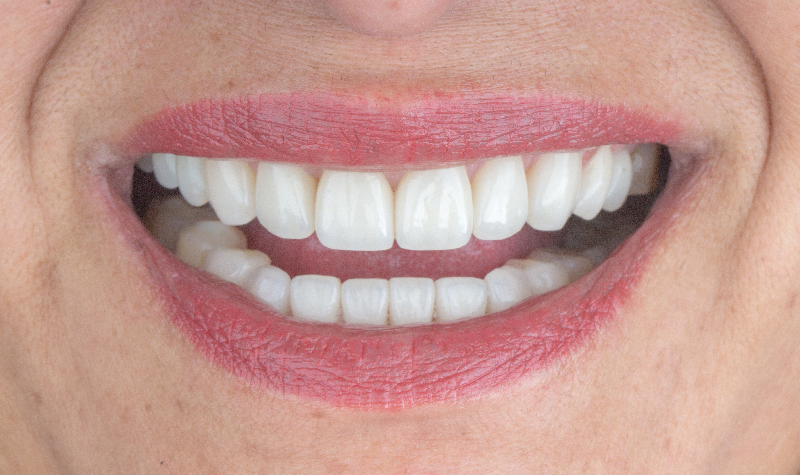 Rehabilitación Oral total Clínica Vallegrande