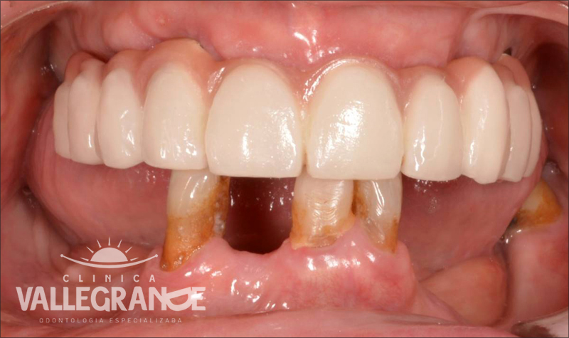Protesis completa fija sobre implantes Clínica Vallegrande