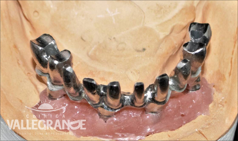 Protesis completa fija sobre implantes Clínica Vallegrande