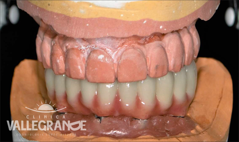 Protesis completa fija sobre implantes Clínica Vallegrande