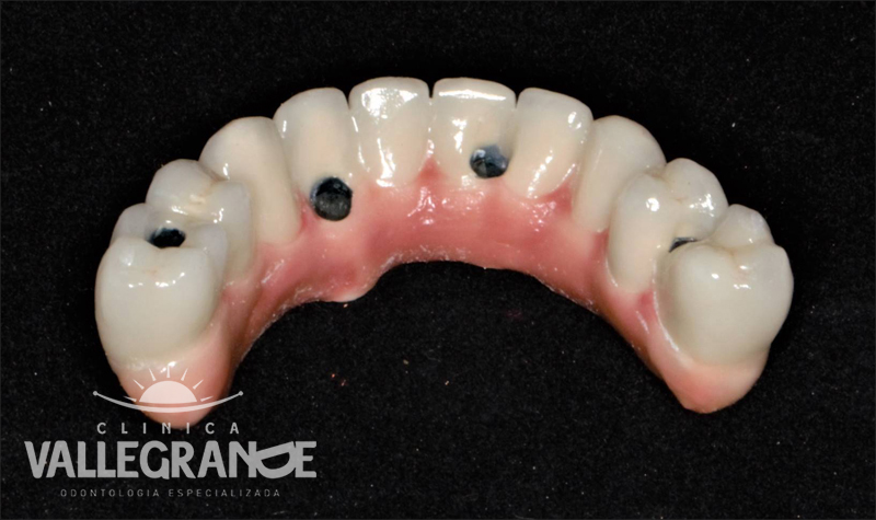 Protesis completa fija sobre implantes Clínica Vallegrande